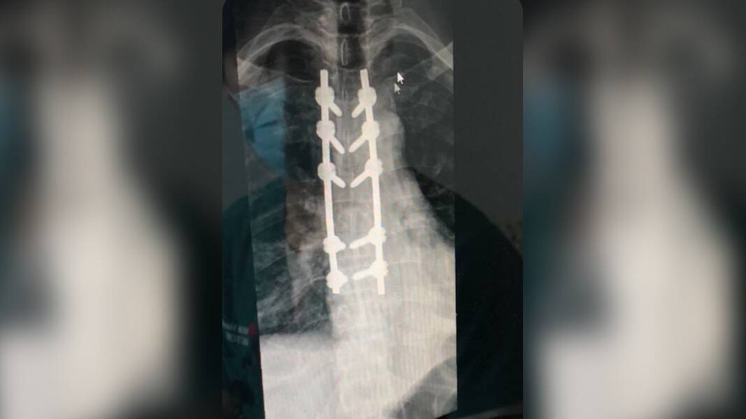 An X-ray of Alex Ballhausen's spine.