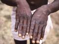 South Australian health officials have reported a first case of monkeypox in a returned traveller.