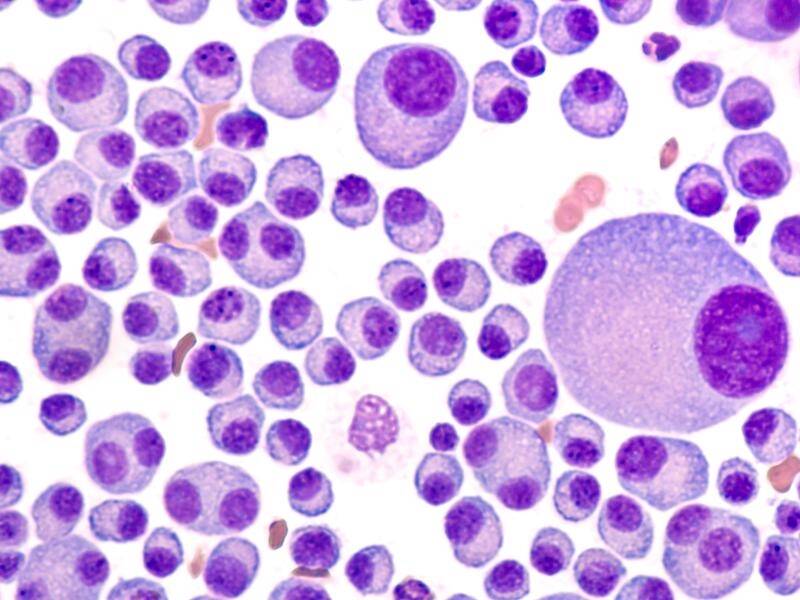 Multiple myeloma occurs when abnormal plasma cells overcrowd healthy blood cells in bone marrow.